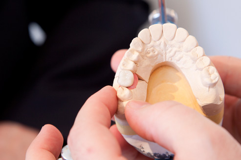 Zahnarzt Weilheim Dr. Raidl – Zahnersatz aus Zirkon
