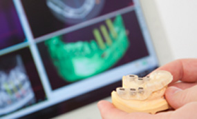 Implantologie mit Bohrschablone – Zahnarzt Dr. Raidl in Pähl bei Weilheim